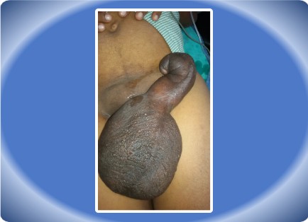FILARIAL SCROTUM